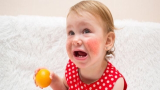 الحساسية الغذائية