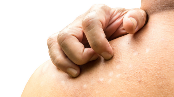 النخالية البيضاء