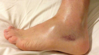 سبب تورم الساق