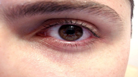 انفصال الشبكية