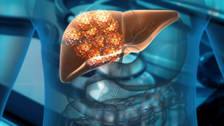 سرطان الكبد