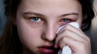 التهاب الملتحمة