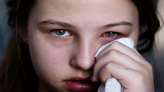 التهاب الملتحمة