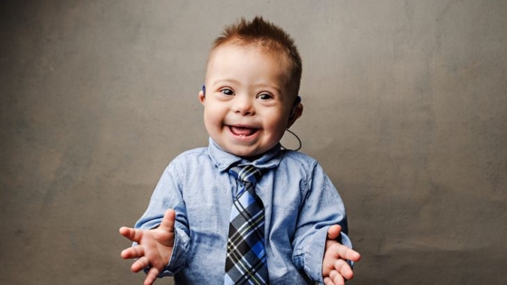 متلازمة داون