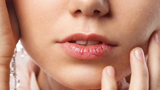 تشققات الشفاه