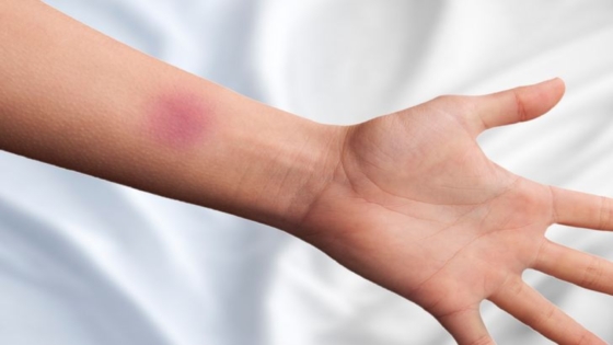 الكدمات على الجلد