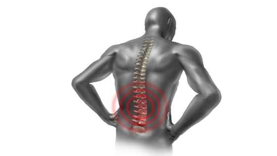 مرض القعس القطني