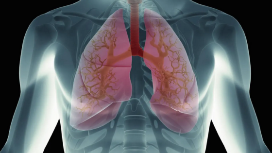 انخماص الرئة