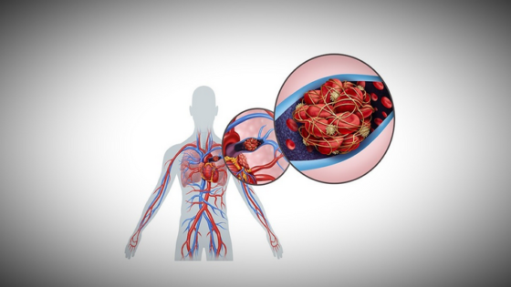 الانصمام الرئوي