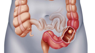 التهاب الرتج