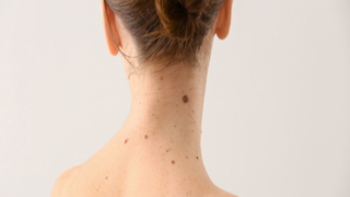 ظهور الشامات