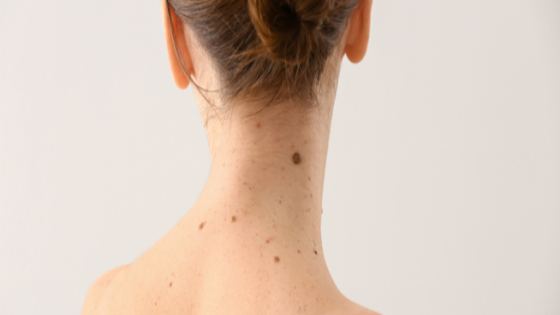 ظهور الشامات