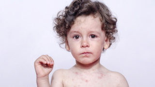 أنواع الحساسية