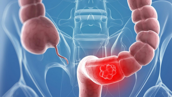 سلائل معوية