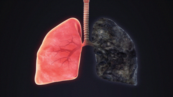 انتفاخ الرئة