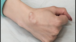 سبب الكيس العقدي