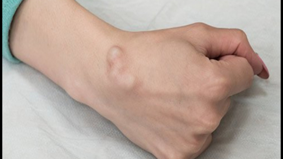 سبب الكيس العقدي