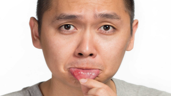 العلاج الفوري لتقرحات الفم