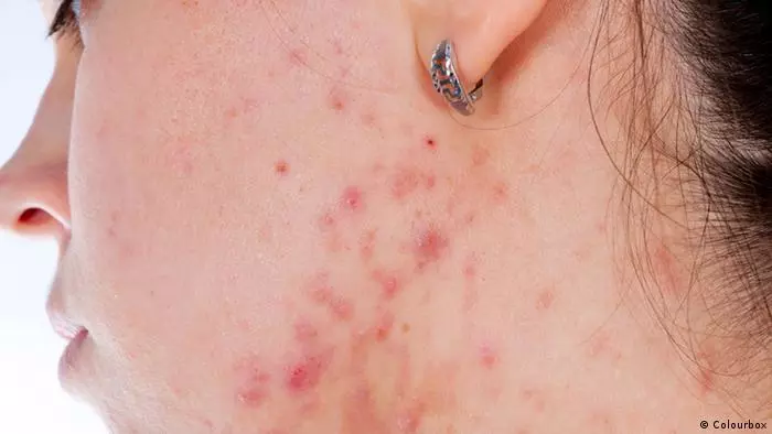  حب الشباب الكيسي