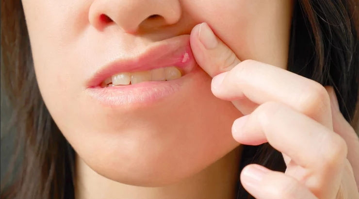 قرح الزكام على الشفاه