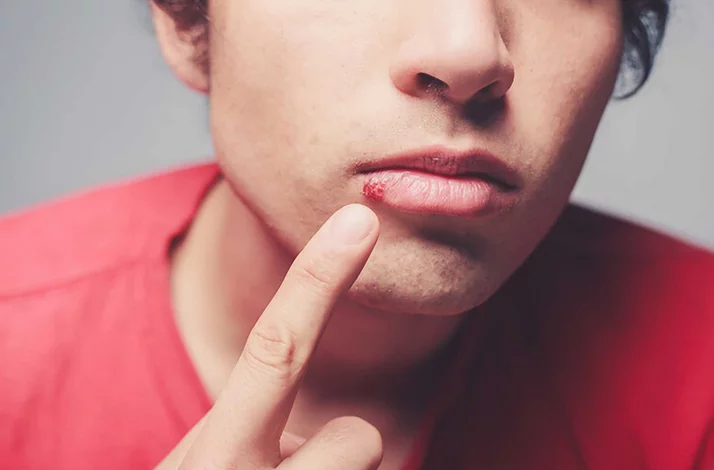 قرح الزكام على الشفاه