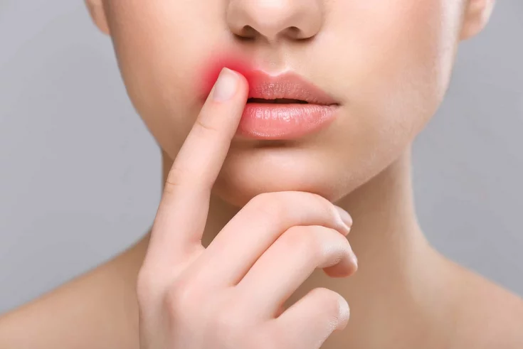 قرح الزكام على الشفاه