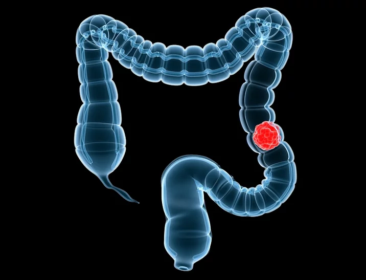التهاب الرتج: السبب، الأعراض، التشخيص، العلاج dd 2 - موقع رموش
