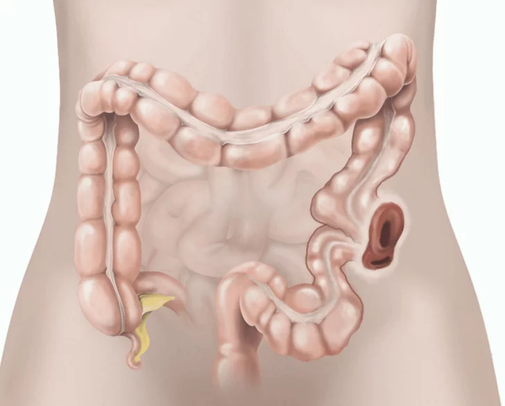 التهاب الرتج: السبب، الأعراض، التشخيص، العلاج jg 1 - موقع رموش