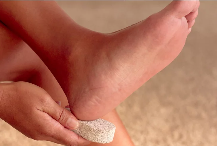 تشقق القدمين