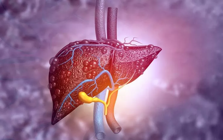 علاج الكبد الدهني