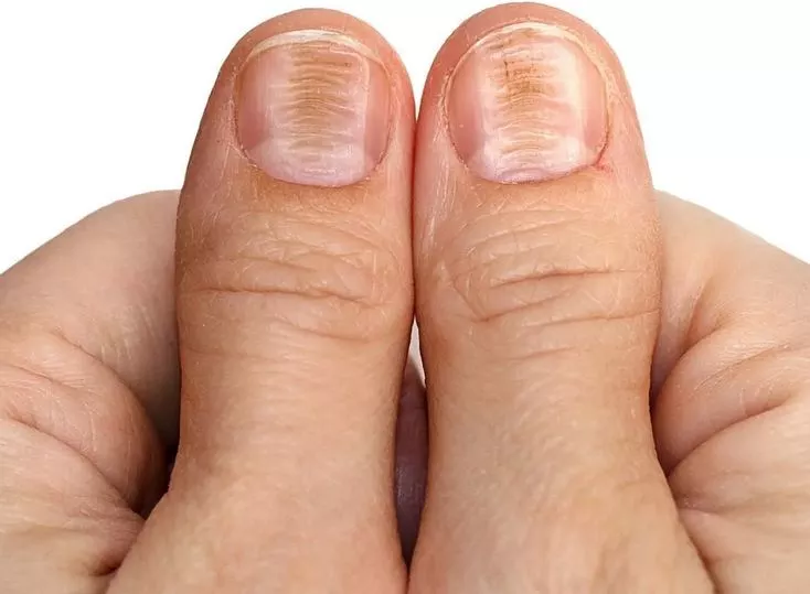 مرض البري بري ينتج عن نقص فيتامين فيه H 2 - موقع رموش