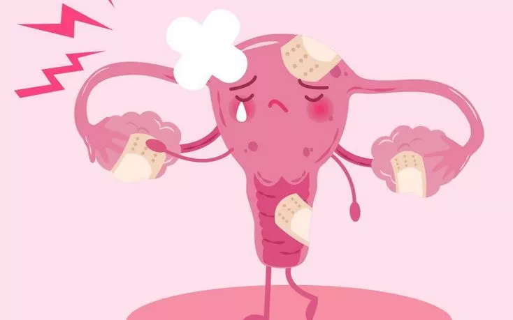 أكياس المبيض