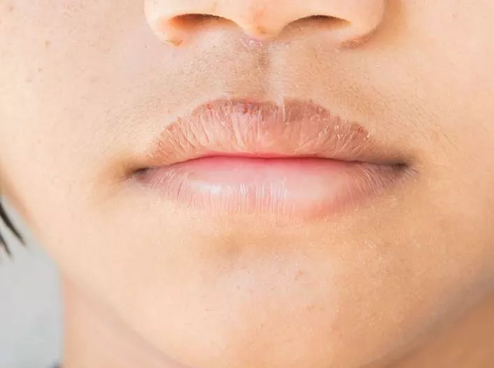 تشققات الشفاه