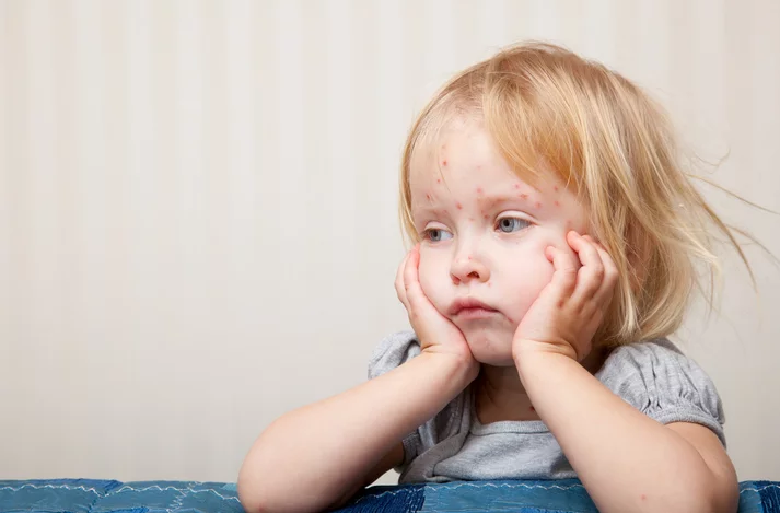 ما هي مخاطر الإصابة بـ الجدري المائي أثناء الحمل؟ gk - موقع رموش