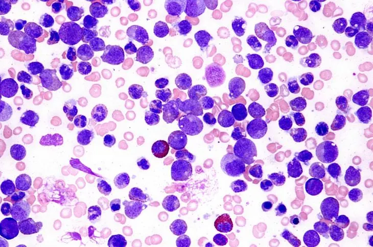 ما هي أولى أعراض اللوكيميا؟ اللوكيميا