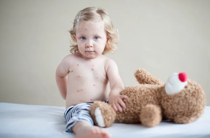 ما هي مخاطر الإصابة بـ الجدري المائي أثناء الحمل؟ الجدري المائي