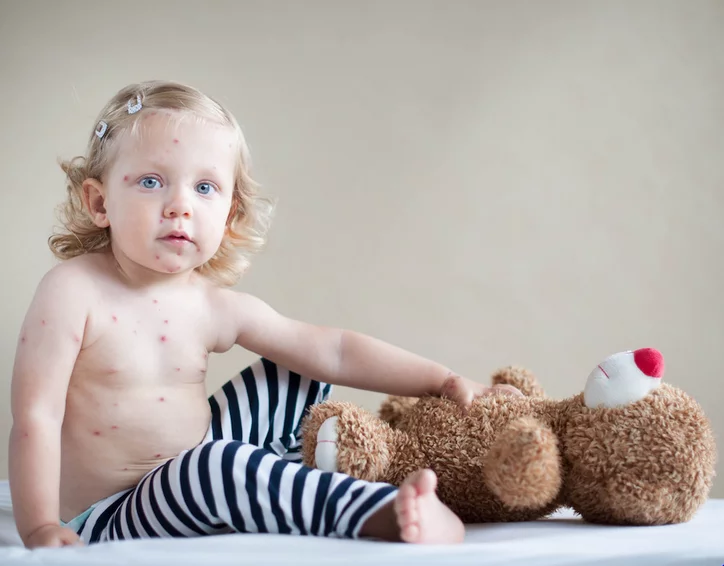 ما هي مخاطر الإصابة بـ الجدري المائي أثناء الحمل؟ الجدري المائي