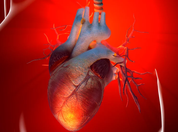 احتشاء عضلة القلب