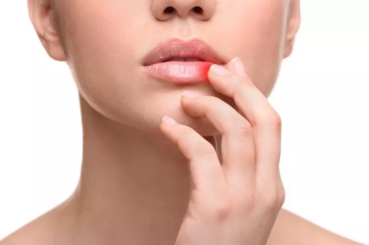 العلاج المنزلي لـ قروح البرد vdeqa - موقع رموش